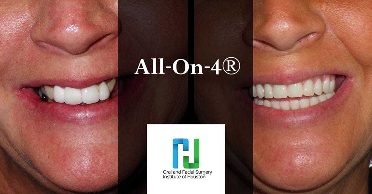 All on 4 Treatment Concept Houston TX