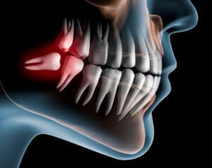 Pain,Caused,By,Wisdom,Teeth, ,3d,Illustration