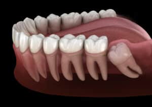 Healthy,Teeth,And,Wisdom,Tooth,With,Mesial,Impaction,.,Medically