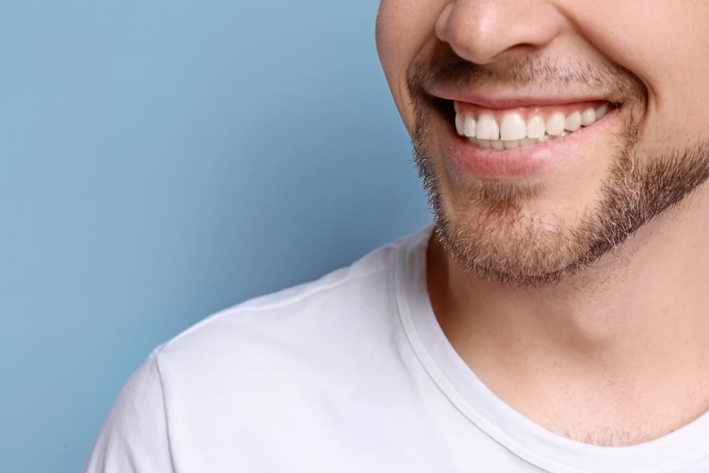 A close-up shot of a man’s teeth after receiving all-on-4 dental implants