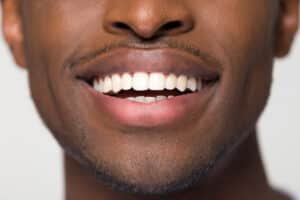 A close-up shot of a man's smile after getting all-on-4 implants in Houston